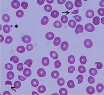 Thrombotic Thrombocytopenic Purpura | Concise Medical Knowledge