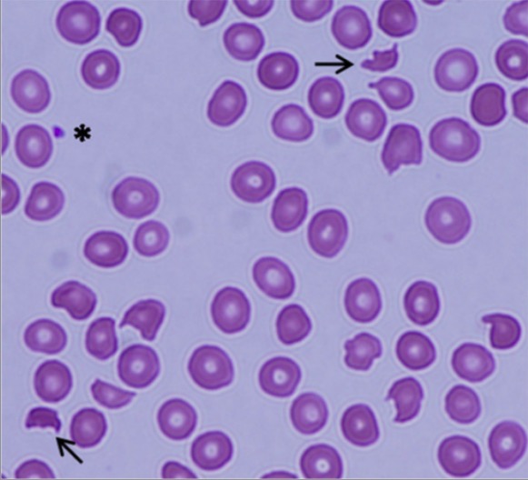 Peripheral blood film showing schistocytes