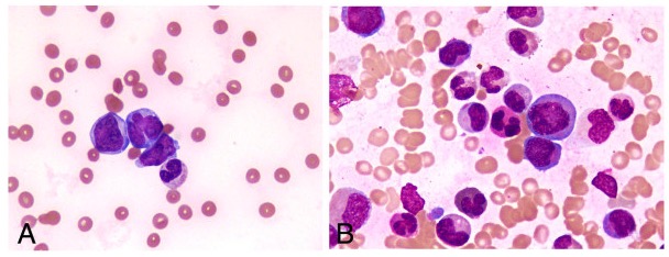 Peripheral blood smear and bone marrow aspirate
