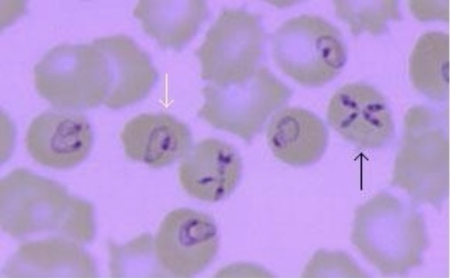 E) Brilliant Babesia piroplasm inside RBC in thick blood smear. (F)