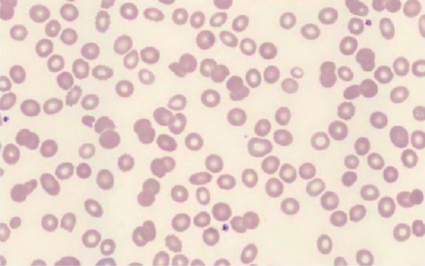 Frotis de sangre periférica que muestra glóbulos rojos normocrómicos con anisocitosis: poiquilocitosis - neutropenia