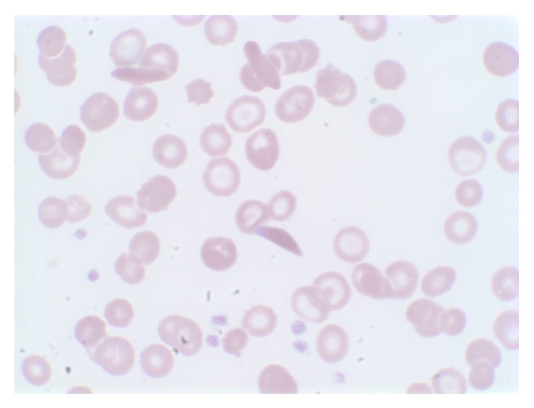 Peripheral blood smear shows irreversible sickled cells, anisocytosis, poikilocytosis, and target cells