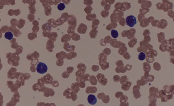 Peripheral blood smear shows rouleaux formation