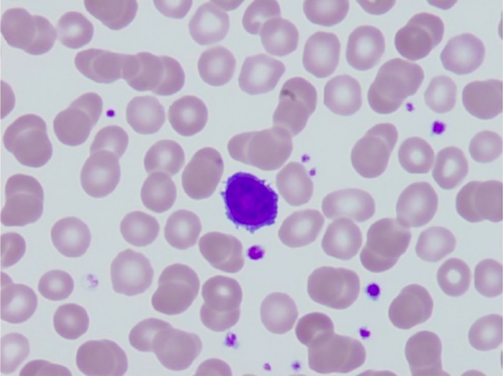 Peripheral blood smear with occasional small lymphocytes