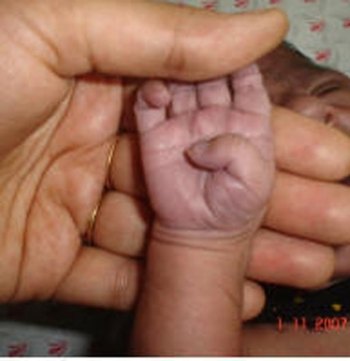 Peripheral cyanosis in a newborn