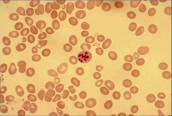Peripheral smear of case 2 demonstrated macrocytosis