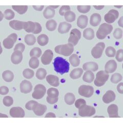 Peripheral blood smear showing a hairy cell