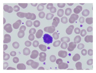 Hairy Cell Leukemia | Concise Medical Knowledge