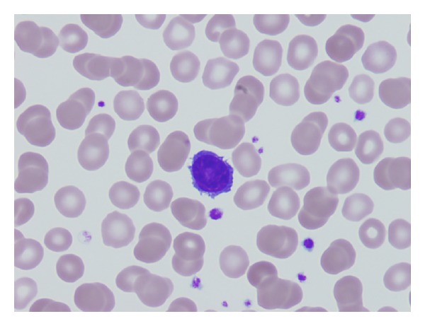 Esfregaço de sangue periférico que evidencia uma célula pilosa