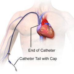 Peripherally inserted central venous catheter