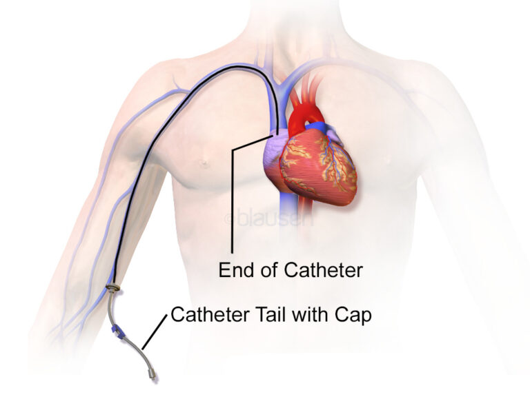 Central Venous Catheter Concise Medical Knowledge