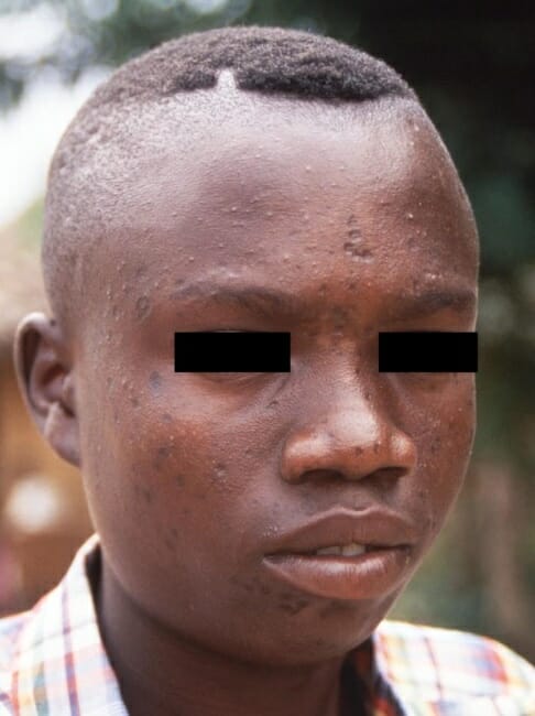 Cicatrizes permanentes da varíola de macaco