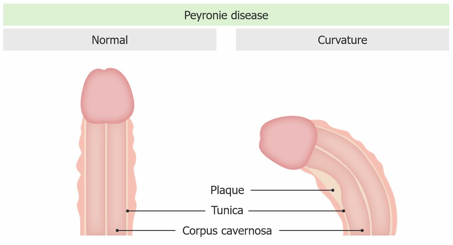 Peyronie disease