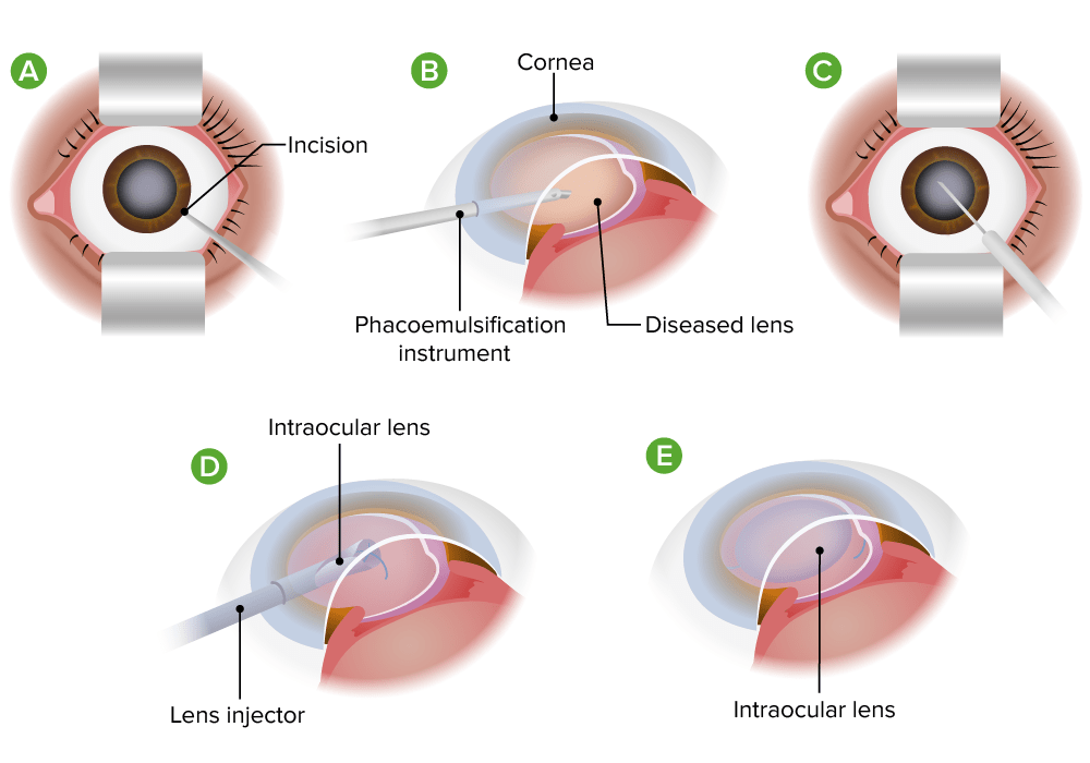 Phacoemulsification for cataracts