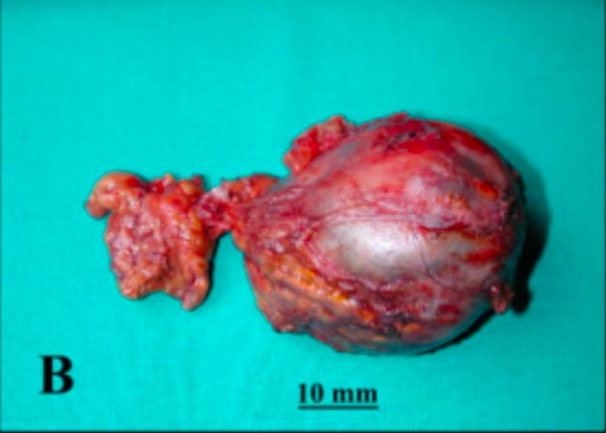 Feocromocitoma  Concise Medical Knowledge