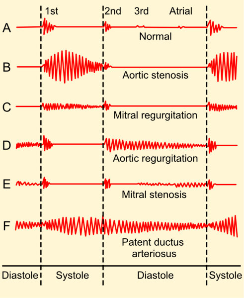 Phonocardiograms_from_normal_and_abnormal_heart_sounds