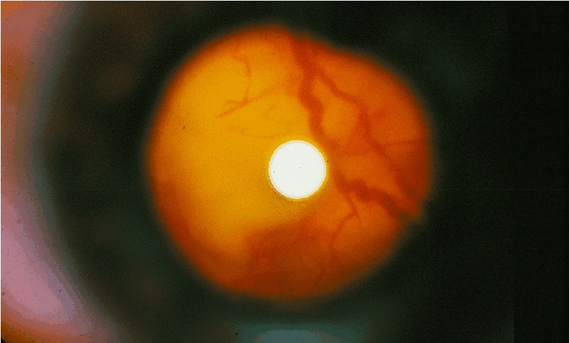 Photo of the fundus in a patient with tuberous sclerosis