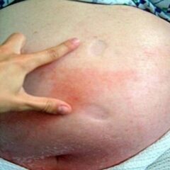 Photograph showing marked pitting edema and erythema with poorly demarcated borders due to cellulitis