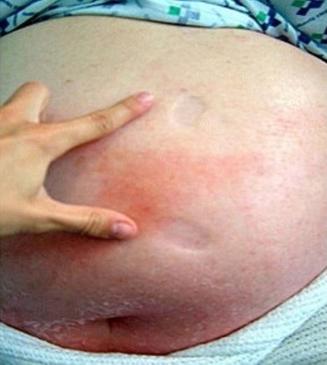 Fotografia mostrando edema depressível marcado e eritema com bordos mal definidos devido à celulite