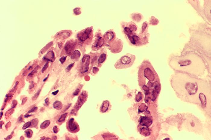 Photomicrograph biopsied esophageal ulcer active herpes simplex virus