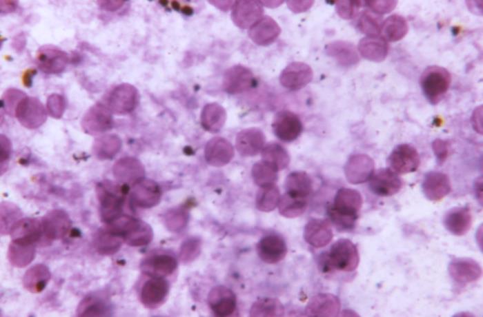 Microfotografía de neumonía por pneumocystis jirovecii