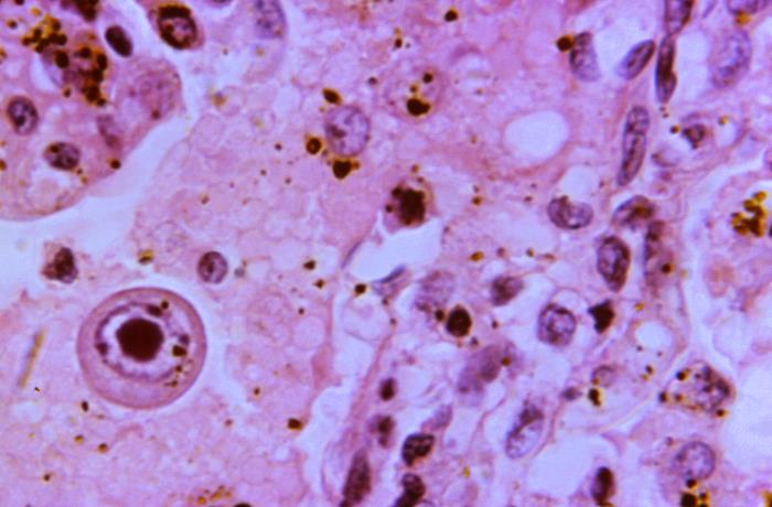 Photomicrograph cytomegalic inclusion cell cytomegalovirus