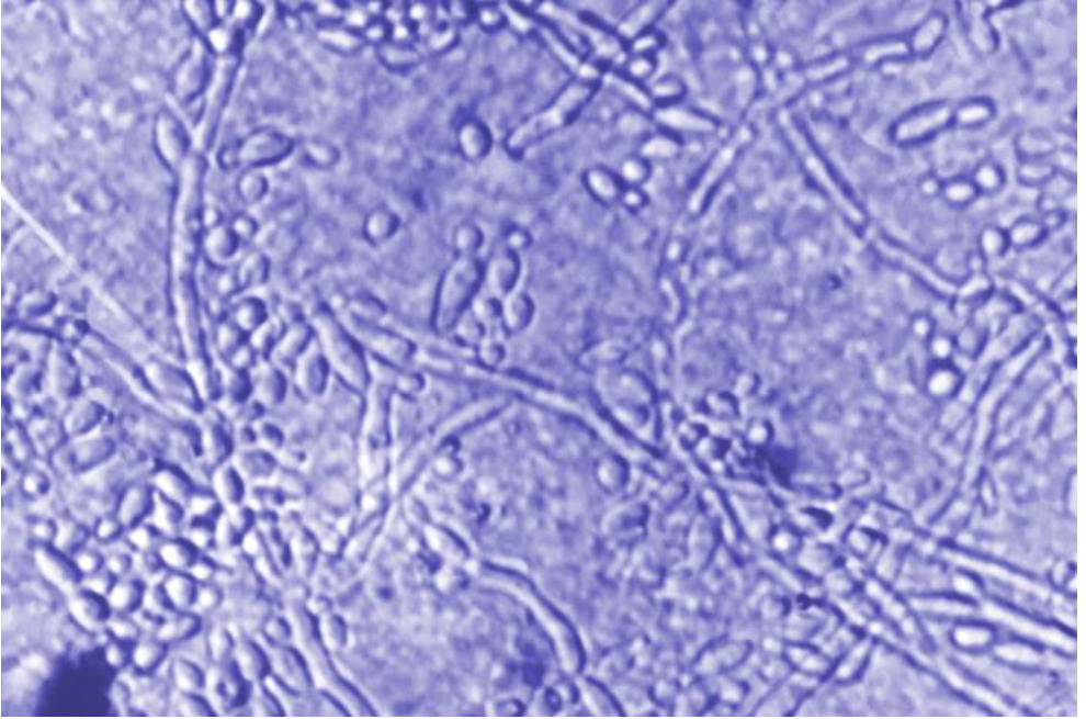 Photomicrograph of candida albicans demonstrating budding yeast cells and hyphae