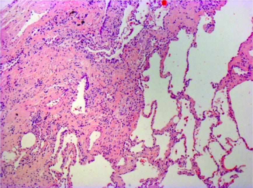 Photomicrograph of biopsy from a 63-year-old man with a multi-disciplinary diagnosis of idiopathic pulmonary fibrosis