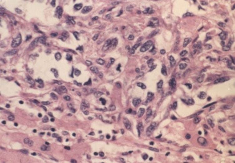 Fotomicrografía de un angiosarcoma hepático