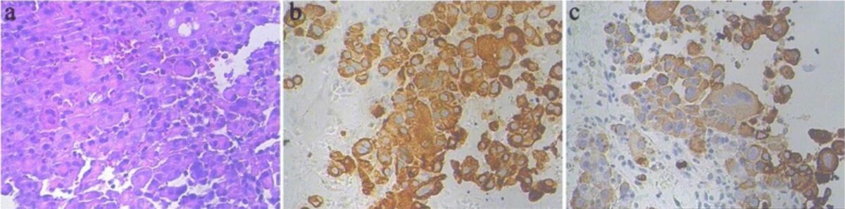 Fotomicrografías de colangiocarcinoma intrahepático