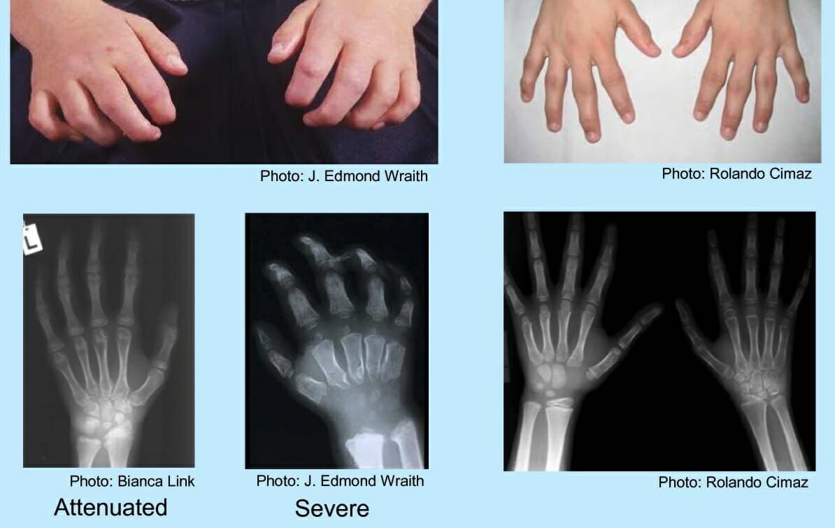 Physical and radiographic appearance of hands in mps i versus juvenile idiopathic arthritis