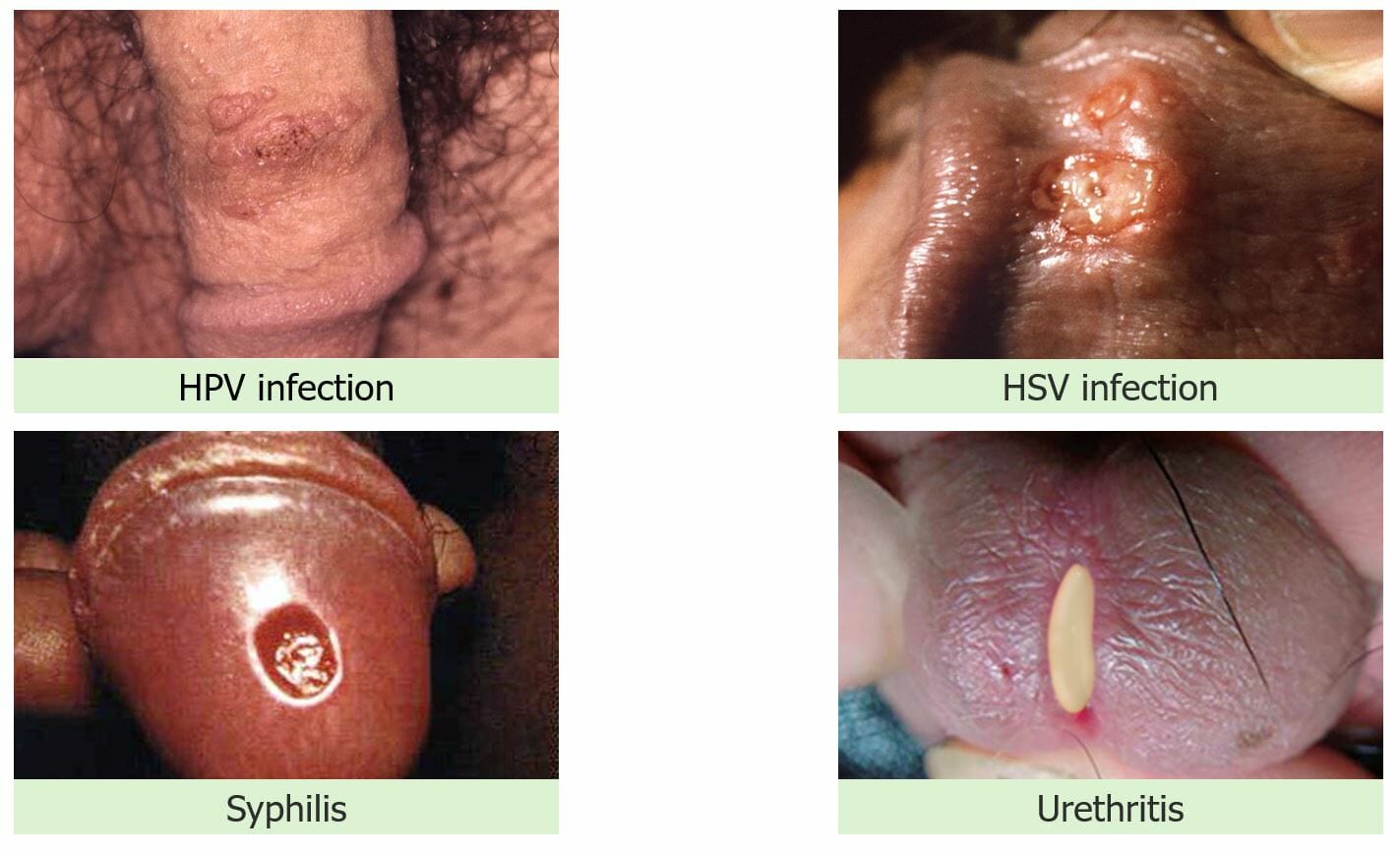 Physical examination findings with stis