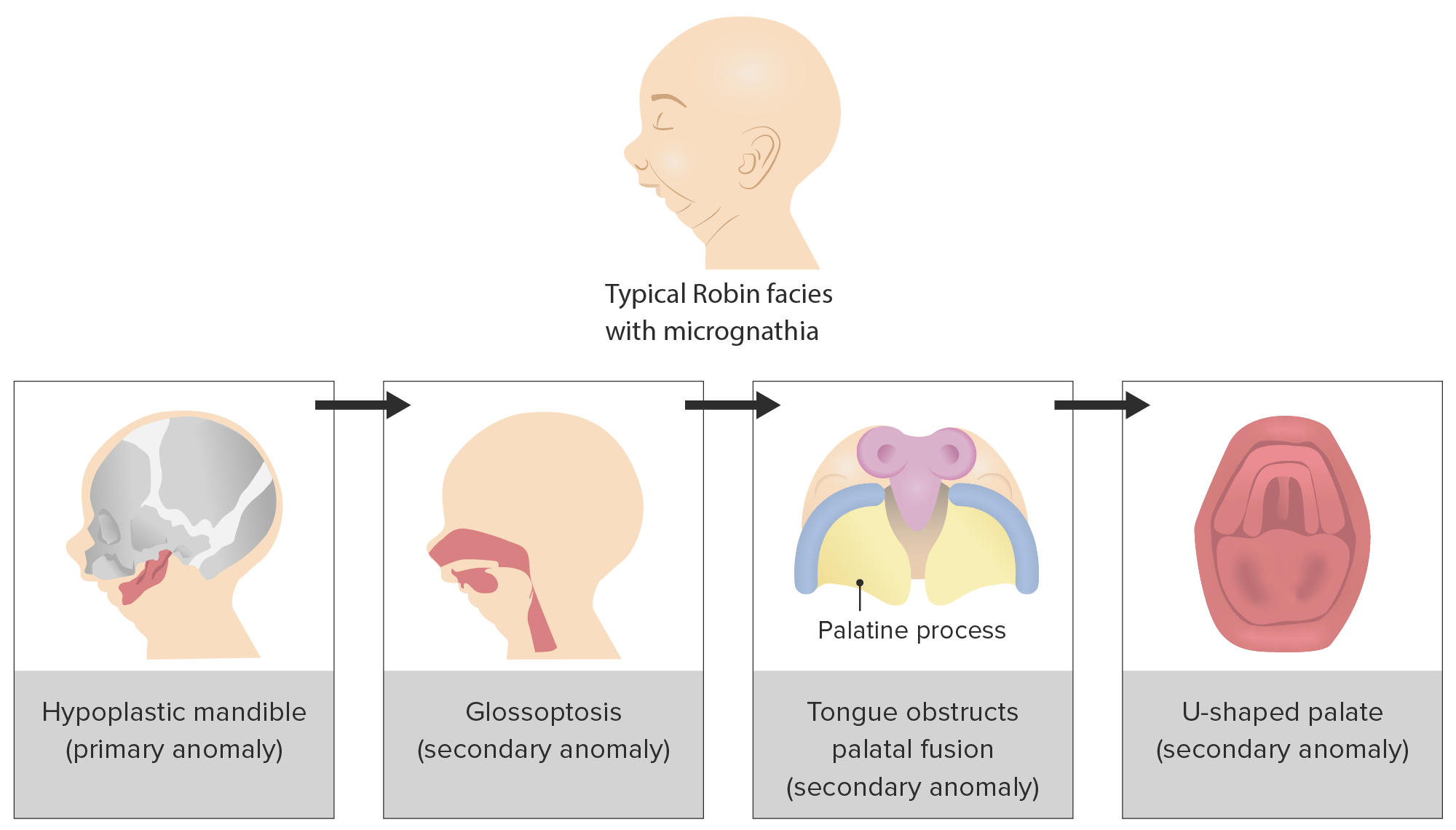 Omphalocele as component of multiple anomaly syndrome/sequence