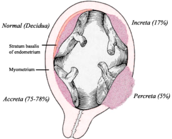 Placenta acreta