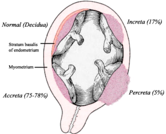 trabajo-de-parto-y-nacimiento-prematuros-concise-medical-knowledge