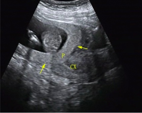 Placenta previa on ultrasound