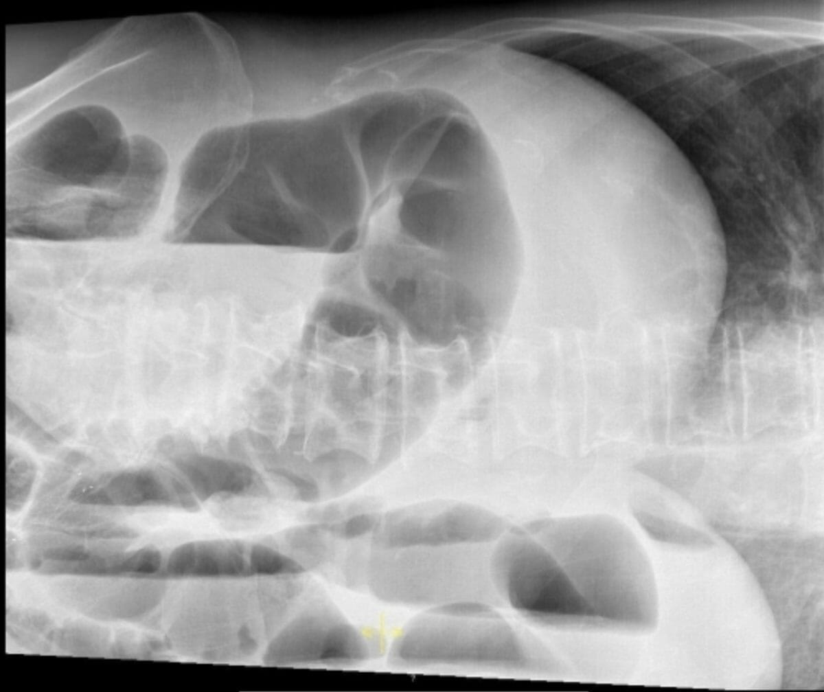 Radiografía simple de abdomen del paciente 2