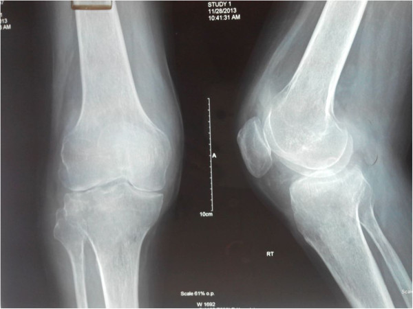 Plain radiograph septic arthritis