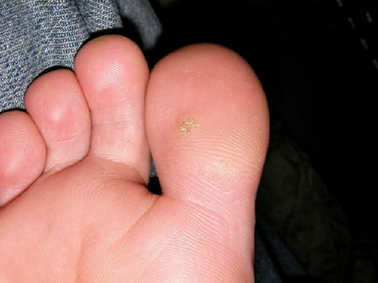 Plantar wart on the bottom of a big toe