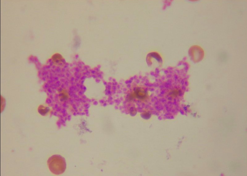 Platelet clumps in a blood smear