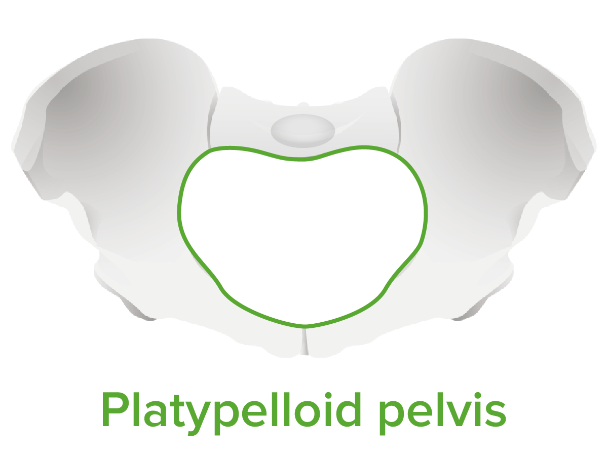 Platypelloid pelvis