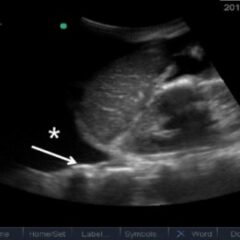 Pleural effusion on ultrasound