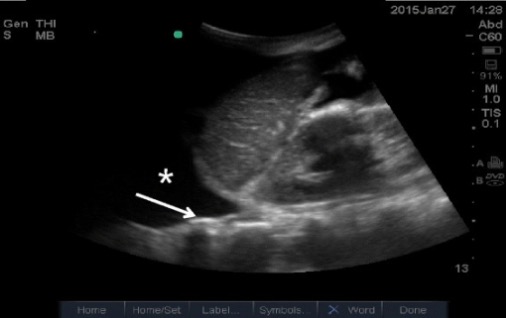 Pleural effusion on ultrasound