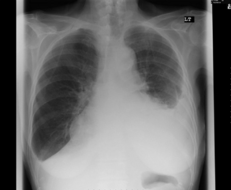 Pleural effusion while being on carbimazole