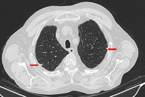 Pleural plaques due to asbestosis