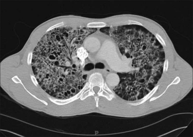 Pneumocystis carinii pneumonia