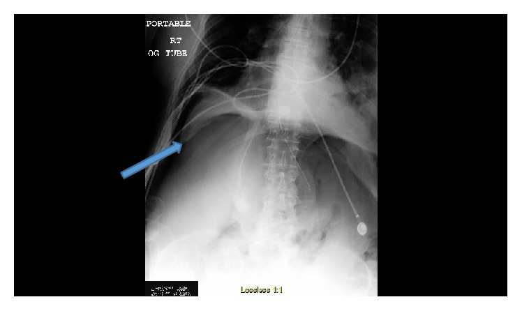 Uma radiografia do tórax/abdómen com pneumotórax direito em paciente com doença pulmonar obstrutiva crónica (dpoc)