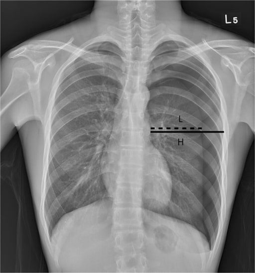 Pneumothorax Concise Medical Knowledge