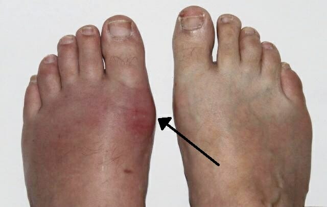 Erythema and swelling of the 1st metatarsophalangeal joint consistent with acute gout