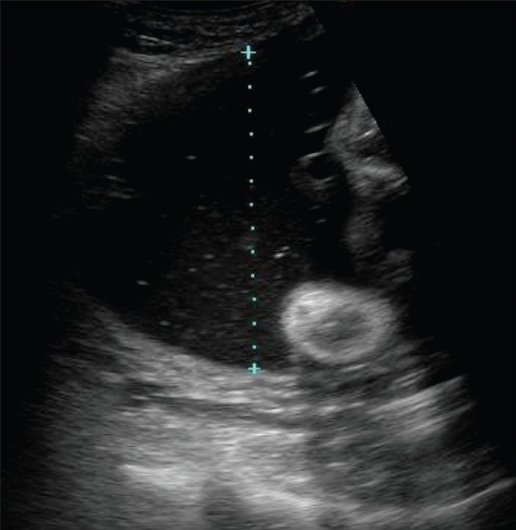 Ultrasound polyhydramnios (excess amniotic fluid) oligohydramnios